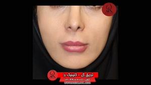 تزریق ژل | فیلم تزریق ژل | کلینیک پوست و مو رز | شماره  55