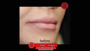  تزریق ژل | فیلم تزریق ژل | کلینیک پوست و مو رز | شماره 48 