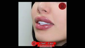  تزریق ژل | فیلم تزریق ژل | کلینیک پوست و مو رز | شماره 49