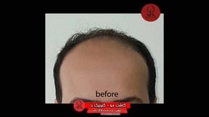 کاشت مو | فیلم کاشت مو | کلینیک پوست و مو رز | شماره 36
