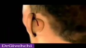مراحل جراحی زیبایی گوش (اتوپلاستی)