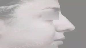 فیلم عمل زیبایی بینی توسط دکتر گیلدا گیوه چی