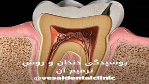 پوسیدگی دندان و ترمیم آن