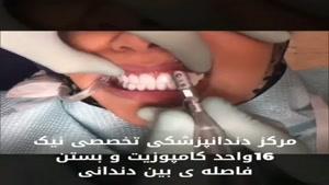 16 واحد کامپوزیت و بستن فاصله ی بین دندانی
