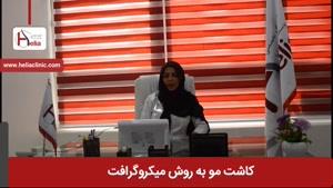 کاشت مو به روش میکروگرافت در ایران | کلینیک هلیا | 02122819418