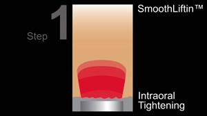 فیلم لیزر فوتونا