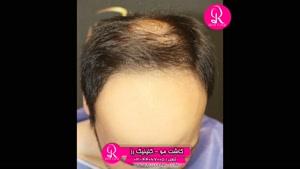  کاشت مو | فیلم کاشت مو | کلینیک پوست و مو رز | شماره 43