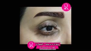 تزریق ژل | فیلم تزریق ژل | کلینیک پوست و مو رز | شماره 63