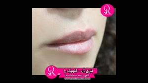تزریق ژل | فیلم تزریق ژل | کلینیک پوست و مو رز | شماره 64
