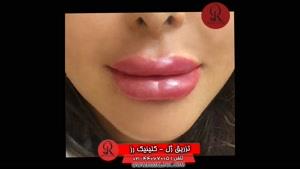 تزریق ژل | فیلم تزریق ژل | کلینیک پوست و مو رز | شماره  56