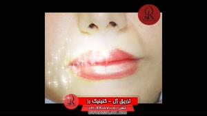 تزریق ژل | فیلم تزریق ژل | کلینیک پوست و مو رز | شماره  57