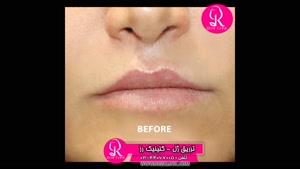 تزریق ژل | فیلم تزریق ژل | کلینیک پوست و مو رز | شماره 60