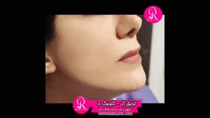 تزریق ژل | فیلم تزریق ژل | کلینیک پوست و مو رز | شماره 65 