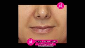  تزریق ژل | فیلم تزریق ژل | کلینیک پوست و مو رز | شماره 61
