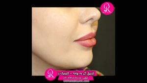  تزریق ژل | فیلم تزریق ژل | کلینیک پوست و مو رز | شماره 62