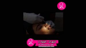 تزریق ژل | فیلم تزریق ژل | کلینیک پوست و مو رز | شماره  58