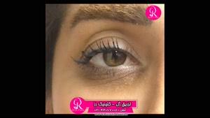 تزریق ژل | فیلم تزریق ژل | کلینیک پوست و مو رز | شماره  59