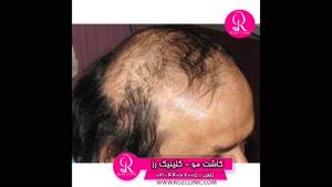 کاشت مو | فیلم کاشت مو | کلینیک پوست و مو رز | شماره 40