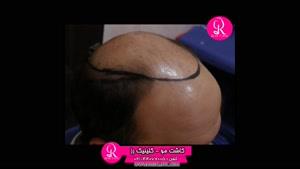  کاشت مو | فیلم کاشت مو | کلینیک پوست و مو رز | شماره 39