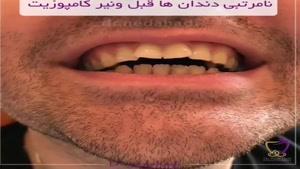 ونیر کامپوزیت دندان 