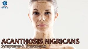بیماری پوستی آکانتوزیس نیگریکانس، علل و روش درمان