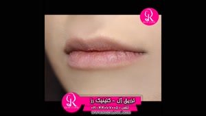 فیلم تزریق ژل | کلینیک رز | 02144067005 | شماره 86