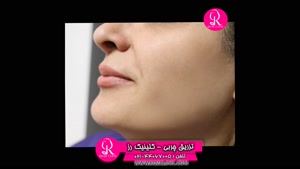 فیلم تزریق چربی | کلینیک رز | 02144067005 | شماره 67