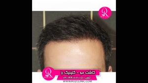 فیلم کاشت مو | کلینیک رز | 02144067005 | شماره 50