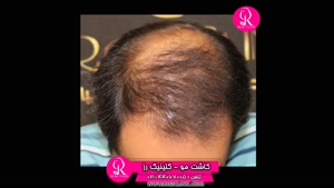 فیلم کاشت مو | کلینیک رز | 02144067005 | شماره 49