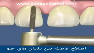 اصلاح فاصله بین دندان های جلو با لمینت زیبایی