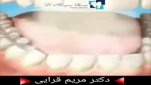  عوارض مصرف سیگار روی دندان