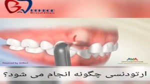 فیلم نحوه ی کارگذاشتن ارتودنسی دندان