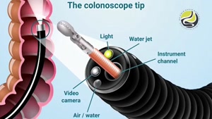 در حین و بعد از کولونوسکوپی چه اتفاقی می افتد؟