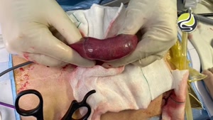 وجود بزوار در روده بیمار در حین کولونوسکوپی