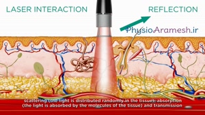 لیزر درمانی نقاط سوزشی  بدن