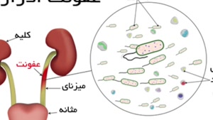 آشنایی با نشانه های بروز عفونت کلیوی 