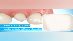  کامپوزیت دندان 