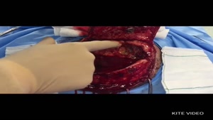 عمل جراحی ترمیم ضایعه استخوانی / دکتر اصغری نوسری