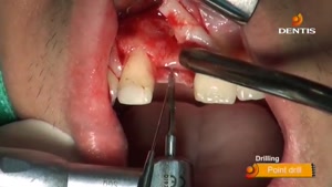 ایمپلنت | کلینیک دندانپزشکی تاج