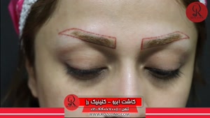 کاشت ابرو | فیلم کاشت ابرو | کلینیک پوست و مو رز | شماره52