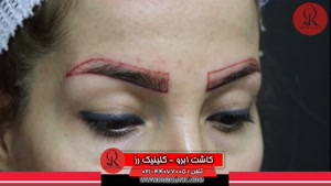 کاشت ابرو | فیلم کاشت ابرو | کلینیک پوست و مو رز | شماره54