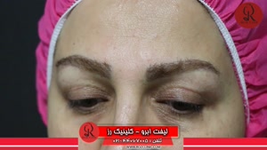 کاشت ابرو | فیلم کاشت ابرو | کلینیک پوست و مو رز | شماره55