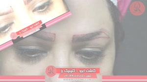 کاشت ابرو | فیلم کاشت ابرو | کلینیک پوست و مو رز | شماره51
