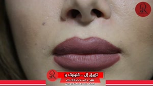 تزریق ژل | تزریق ژل لب | فیلم تزریق ژل | کلینیک پوست و مو رز | 18