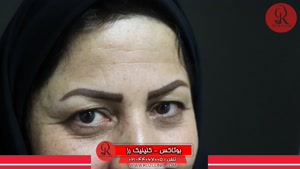 تزریق بوتاکس | فیلم تزریق بوتاکس | کلینیک پوست و مو رز |13