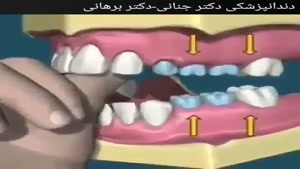 عوارض عادت های نامطلوب دهانی در کودکان