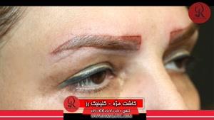 کاشت ابرو و مژه| فیلم کاشت ابرو | کلینیک پوست و مو رز | شماره92