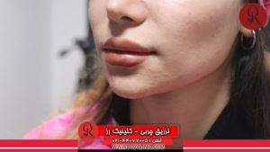 تزریق چربی | فیلم تزریق چربی | کلینیک پوست و مو رز | شماره33