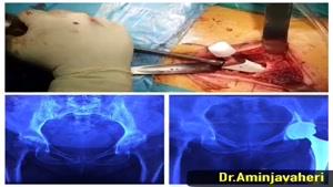 قرار دادن پروتز در استخوان ران توسط دکتر علیرضا امین جواهری