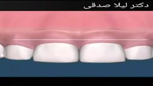 افزایش طول تاج دندان